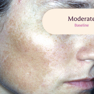 Tretinoin Cream 0.05% for melasma treatment.