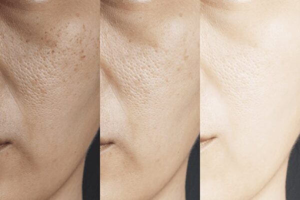 Before & After: Hydroquinone Cream, skin lightening treatment.