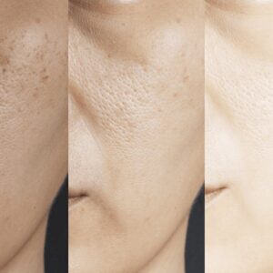 Hydroquinone & Retinol serum. Dual-action skincare product.