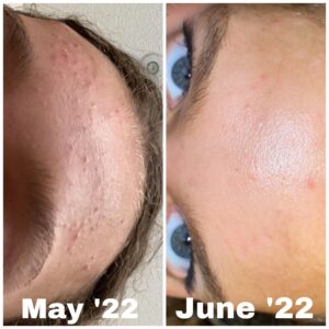 Cerave Moisturizing Cream with Tretinoin.