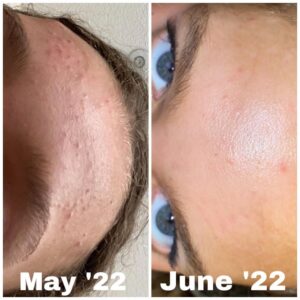 Cerave Tretinoin acne treatment cream tube