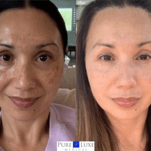 Zo Skin Health Pigment Control: Before & After.