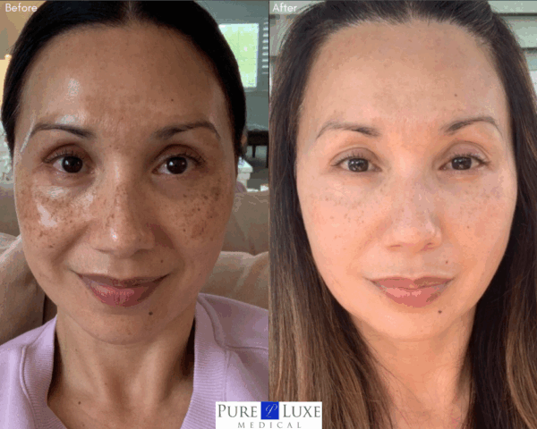 Zo Skin Health Pigment Control: Before & After.