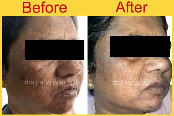 Hydroquinone 4% before & after skin treatment results.