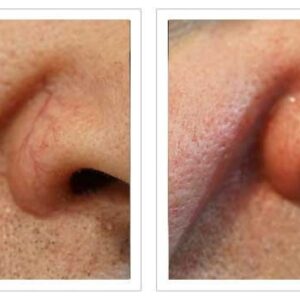 Tretinoin cream for treating broken capillaries.