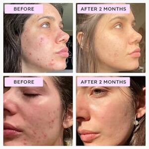 Azelaic Acid & Retin-A skincare product