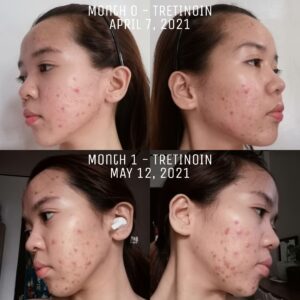 Tretinoin Uglies Reddit: Before & After photos showing skin improvement.