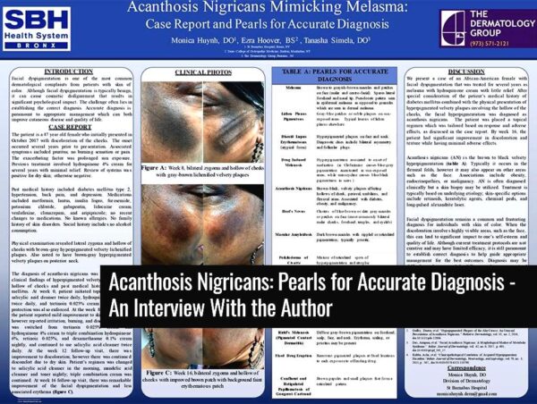 Tretinoin cream for acanthosis nigricans treatment.