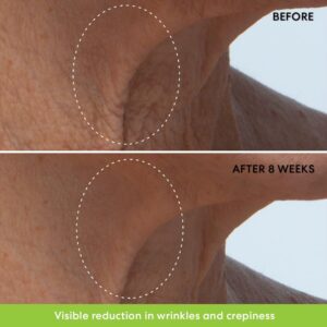 Tretinoin cream for neck wrinkles.
