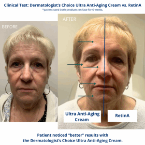 Topical tretinoin before & after: skin improvement results.