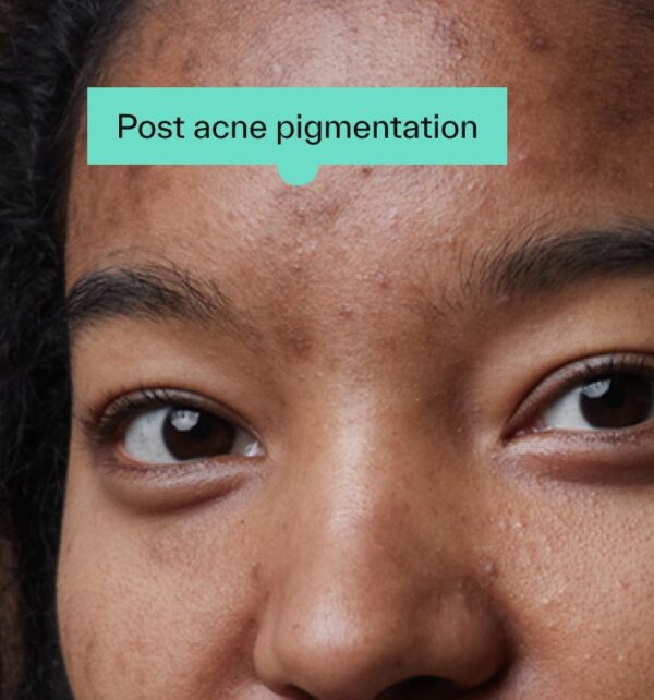 Tretinoin cream for hyperpigmentation treatment.