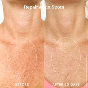Retin-A chest treatment: before & after photos showing improved skin texture.