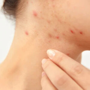 Tretinoin cream for folliculitis treatment.