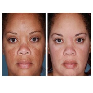 Skin Brightening Hydroquinone cream.