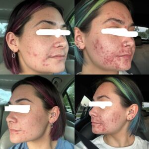 Acretin acne treatment medication.