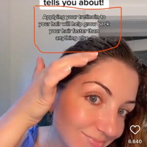 Tretinoin scalp treatment.
