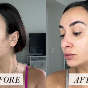 Retin-A before & after: showing improved skin texture and tone.