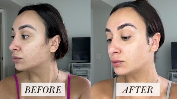 Retin-A before & after: showing improved skin texture and tone.