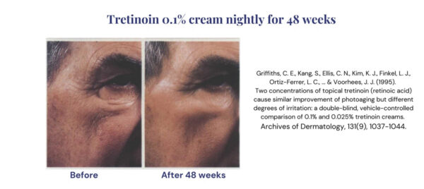 Before & after photos showcasing Retinol Tretinoin results.