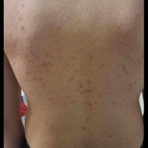 Tretinoin cream for back acne treatment.