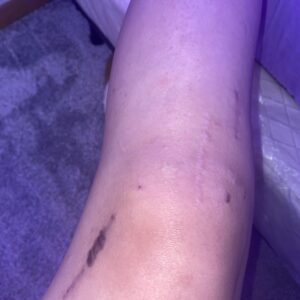 Tretinoin cream for surgical scar treatment.