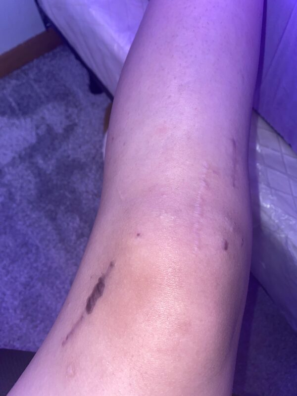Tretinoin cream for surgical scar treatment.