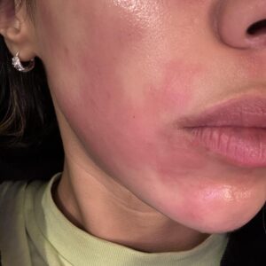 Tretinoin cream burn: irritated skin showing redness and potential peeling.