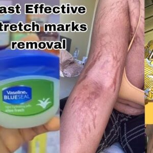 Tretinoin Stretch Mark Cream jar