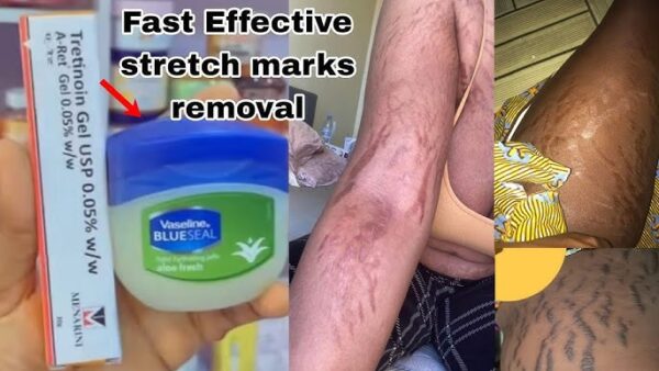 Tretinoin Stretch Mark Cream jar