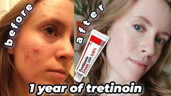 Retin-A 0.05% cream before & after results.