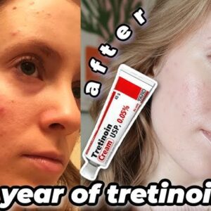 Tretinoin Cream 0.05% before & after results.