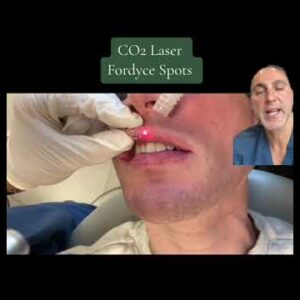 Fordyce Spots Tretinoin cream tube