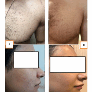 Clindamycin Phosphate & Tretinoin Gel for wrinkle treatment.