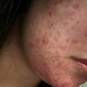 Tretinoin cream for rosacea treatment.