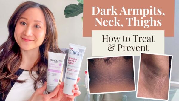 Tretinoin cream for underarm lightening.