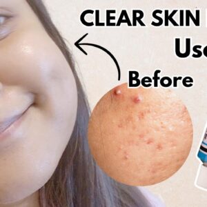 Tretinoin Cream 0.025% USP: Before & After results.