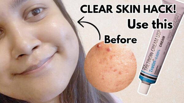 Tretinoin Cream 0.025% USP: Before & After results.