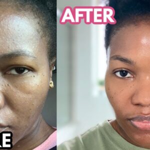 Tretinoin cream for dark skin tones.