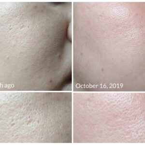 Tretinoin cream for large pores.