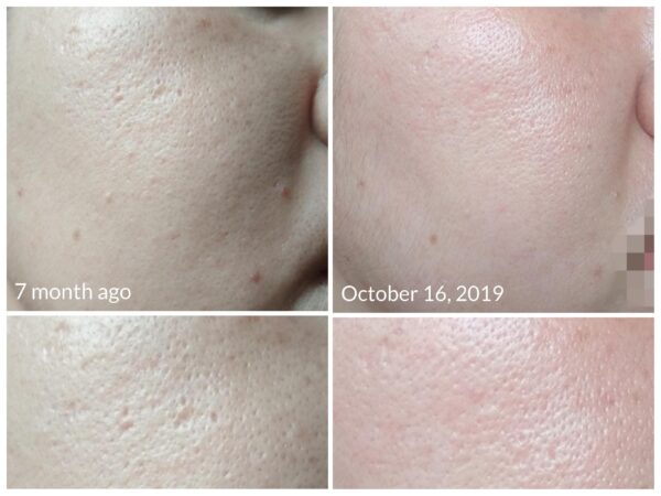Tretinoin cream for large pores.