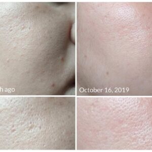 Tretinoin 0.025% cream for open pores.