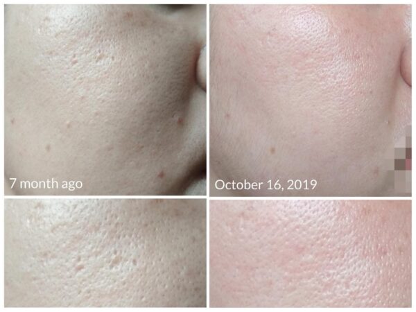 Tretinoin 0.025% cream for open pores.