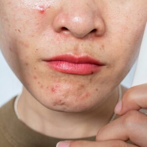 Retin-A applied to a pimple.