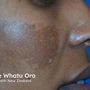 Skin whitening cream for melasma & pigmentation.