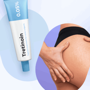 Tretinoin Cream 0.05% for stretch mark treatment.