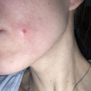 Tretinoin cream applied to acne.