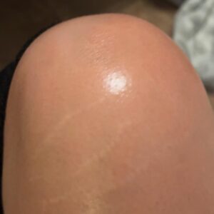 Tretinoin cream for stretch mark treatment.
