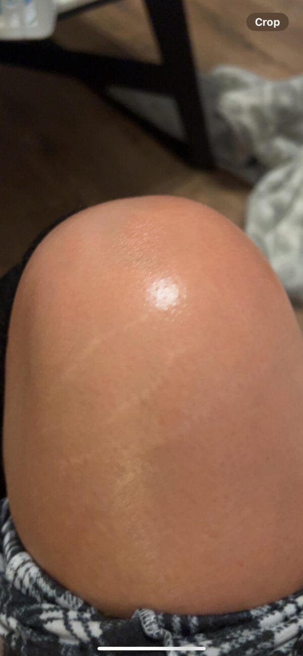 Tretinoin cream for stretch mark treatment.