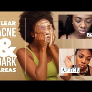 Tri Luma skin lightening cream for African American skin.