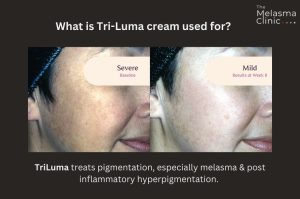 Tri Luma hyperpigmentation cream.